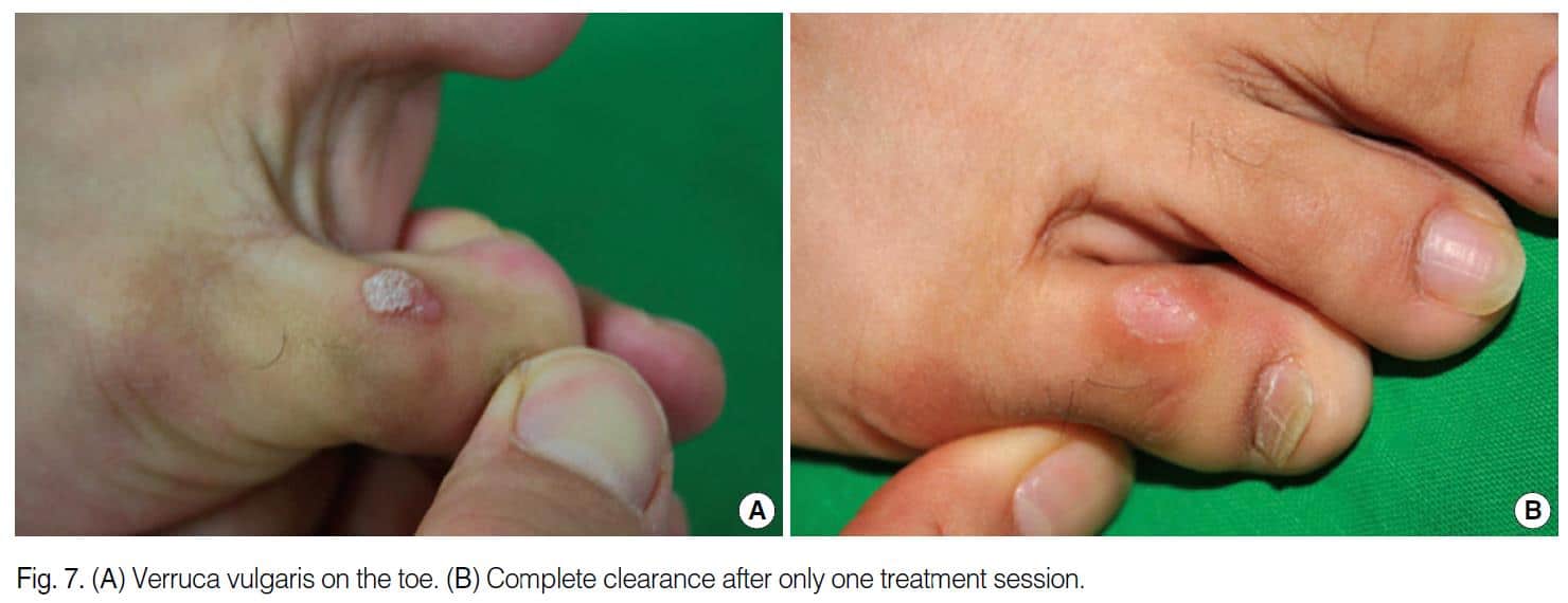 Laser-treatment-for-warts