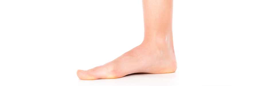 Flat feet (pes planus)