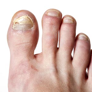 Fungal nail - Entire Podiatry