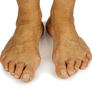 Hammertoe - Entire Podiatry