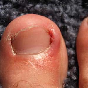 Do Ingrown Toenails Go Away on Their Own?: Town Center Foot & Ankle:  Podiatry