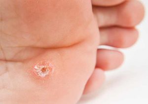 Picture of a plantar wart on feet