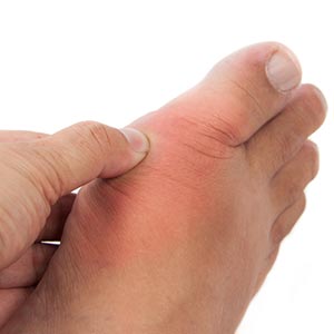 Toe Arthritis