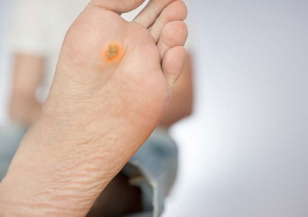 wart on foot of child