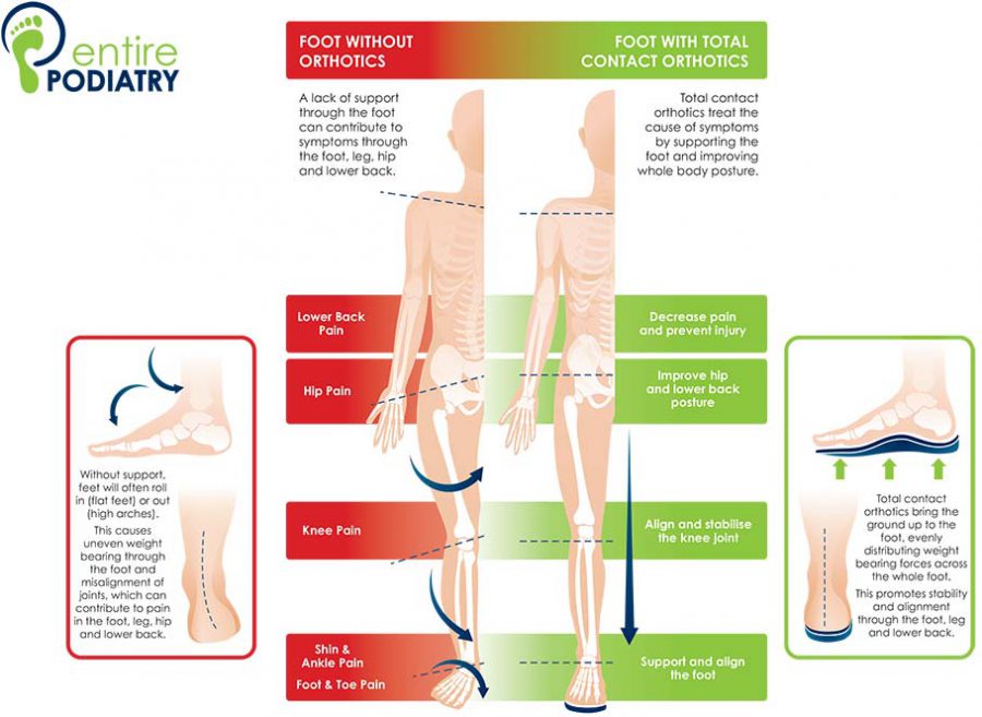 Do I need orthotics? Entire Podiatry