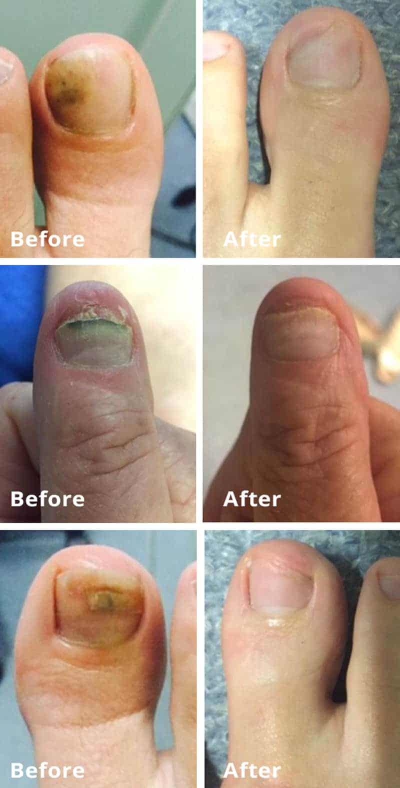 Fungal Nail Laser Podiatry Results