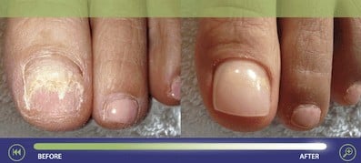 Keryflex Cosmetic Nail Restoration - Before And After Photos 3