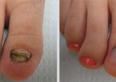Keryflex Nail Restoration Before and After Photo