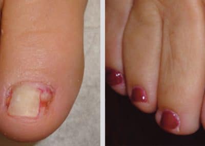 Keryflex Fake Nail - Before and After Photo of a Woman's foot with nail polish