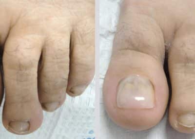 Nail Restoration For Men Using Keryflex
