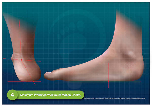 Overpronated Feet - View Podiatrist Recommended Maximum Motion Control Shoes