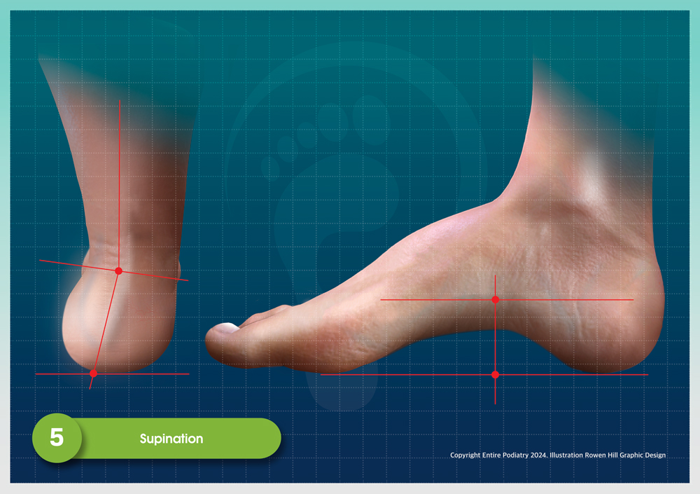 Podiatrist Recommended Shoes for Supinated Feet or Underpronation